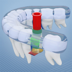 Link zur TPP-Implantation
